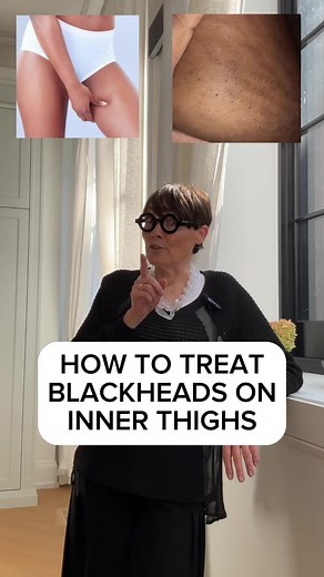 How to treat blackheads on inner thighs #innerthigh #innerthighproblems #extractions #exfoliation #exfoliateyourskin #physicalexfoliation #chemicalexfoliation #barsoap #madamesweat #madamesweatisconcerned #madamesweatkaianaturals #kaianaturals