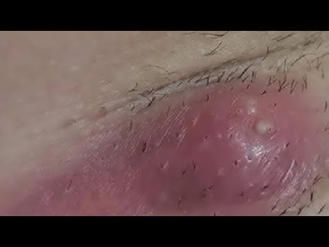 EASILY REMOVE YOUR BOIL SIMPLE STEPS
