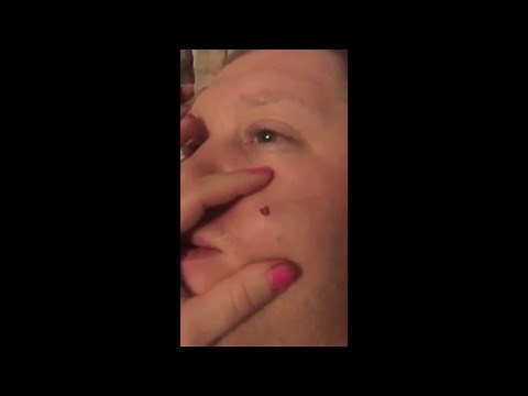 Giant pimple explosion!! *MUST WATCH*