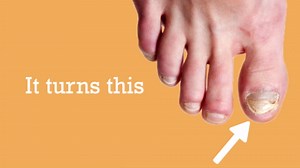 Baar Products - Toelieva Antifungal Liquid Solution - 25% Undecylenic Acid, Organic Olive Oil, Grapefruit Seed Extract - Maximum Strength - Fights Fungus Under & Around Toenails - 2 oz