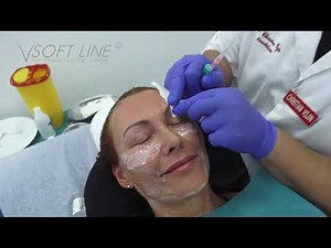 Full Face Procedure - V Soft Line PDO-trådlyft | PDO-Threads by V Soft Lift