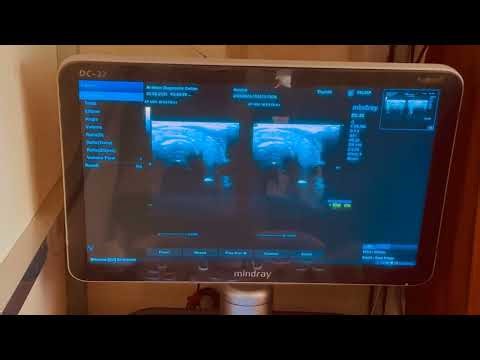 Ultrasonography of Neck & Thyroid Gland with Linear Probe