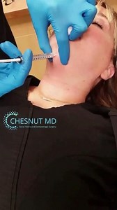Defining the Jowls, Jawline, and Neck With Kybella