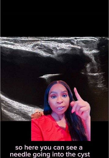 Understanding Breast Cysts: Relief and Treatment Options