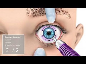 MicroPulse TLT with MicroPulse P3 Probe: Quadrant Approach