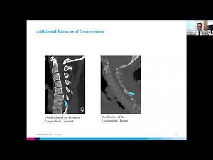 Cervical Spondylotic Myelopathy, Salazar Jones, MD