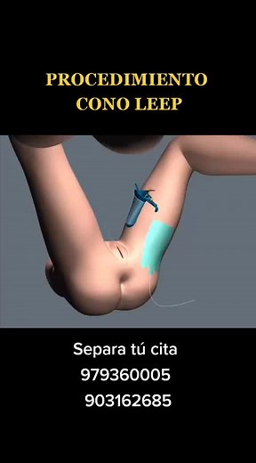 Explicación del procedimiento: CONO LEEP#cancerdecuellouterino #cancerdemama #senologia #cancerdeovario #prevenciondecancer #ginecologiaoncologica #cancerginecologico #ginecologiayobstetricia #CancerdeEndometrio #colposcopia #chiclayo #oncologia