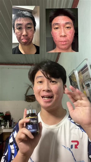 Mình uống kẽm từ lúc mụn nặng và thấy nó hỗ trợ rất tốt cho sức khoẻ của mình, cả nhà có thể tham khảo nhé (lưu ý mình uống kẽm trong lúc bị mụn chứ không phải uống kẽm là sẽ hết mụn nhé) #leannhien #mụn #rungtoc #leannhienreview