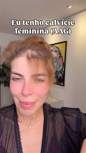Monique Cipriano | Alopecia & Autoestima on Instagram: "Meu caminho para ver resultados para a minha calvície feminina (a famosa Alopecia Androgenética), foi esse: 1- Encontrei uma Tricologista de confiança, que me explicou com ciência e paciência cada detalhe da Alopecia Androgenética; 2- Fiz meu check-up sanguíneo para entender como estavam minhas taxas antes de começar qualquer protocolo; 3- Iniciei o tratamento com Mesoterapia, PRP, LED Terapia e medicamentos orais indicados para o meu caso;