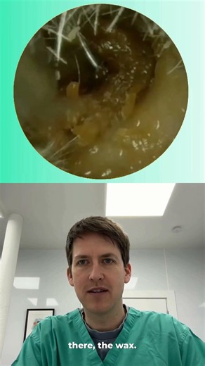The Most SATISFYING Earwax Removal