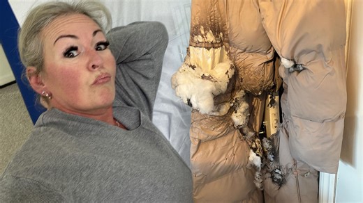 Mum shares horrific photos after vape blew up leaving her covered in blisters