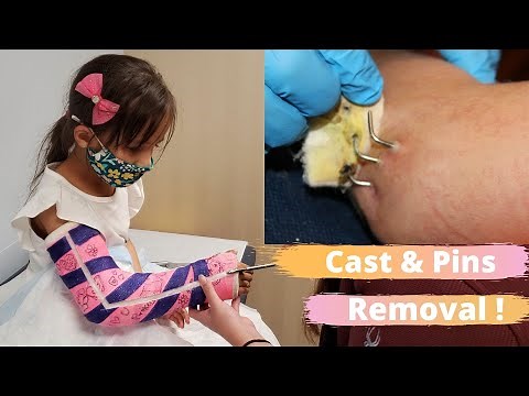 Broken Arm CAST and PINS Removal😱😢(Graphic)!5 Yr Old Gets Her Cast Off and 3 Pins Removed From Elbow