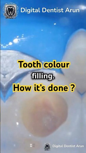 From Cavity to Perfect Smile: How a Composite Filling Restores Your Tooth!