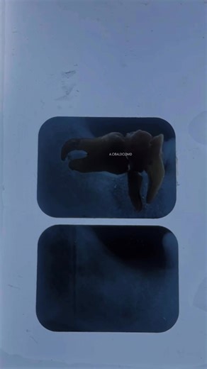 Problematic wisdom teeth are NECESSARY to remove to avoid damaging the neighboring structures such as gums, teeth, and bones. #DentalClinicinTaguig #DentalClinicnearme #TaguigDentist #Paterosdentalclinic #paterostaguigdentist | G.O. Dental Clinic - Taguig City