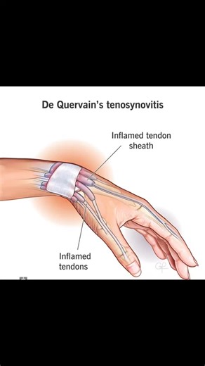Radiology @all abnormalities 🥏🥏 on Instagram: "Ultrasound Report – Right Wrist Presentation Atraumatic onset of pain on the radial side of the right wrist for the last 4–5 weeks. Patient Data Age: 45 years Gender: Female Findings At the first dorsal extensor compartment of the right wrist, there is thickening of the common extensor retinaculum involving the abductor pollicis longus (APL) and extensor pollicis brevis (EPB) tendons. Anechoic fluid is seen within the tendon sheath distal to the a