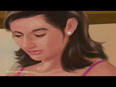 Comedones - Pocket Dictionary of Dermatology