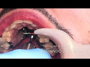 MARPE Skeletal Maxillary Rapid Expansion