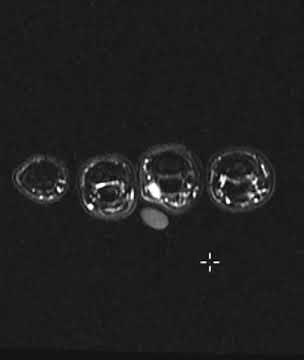 Ganglion cyst of middle finger