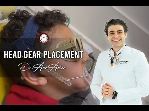 Head gear placement in orthodontics facebow high pull+activator in class II skeletal Dr. Amr Asker