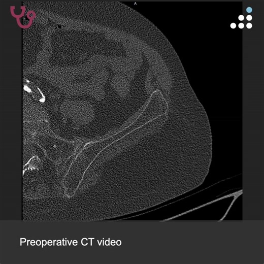 Orthobullets on Instagram: "Here is a new case by Dr. Thomas Bernasek and Florida Orthopaedic Institute @fl_ortho. PERIPROSTHETIC FEMUR FRACTURE NONUNION IN 67F This case will be debated at the Tampa Revision Arthroplasty Course in Tampa, Florida, March 27-28, 2026. HPI: The patient is a 67-year-old female with a history of recurrent falls who presents with progressive left hip pain that has worsened to the point that she has limited mobility. She had bilateral total hip arthroplasty performed i