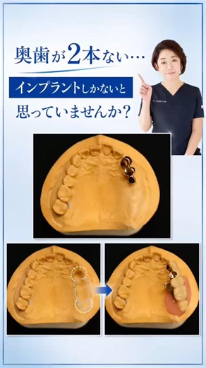 Missing two back teeth? Don't think implants are your only option. #TelescopeDenture #GermanDentures
