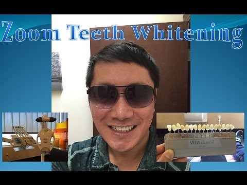 Zoom Laser Teeth Whitening Review | Is It Worth The Money?