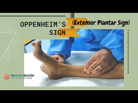 Oppenheim’s sign : extensor plantar response #babinskireflex #umn lesion #cns #reflex #neurology