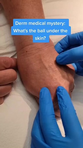 Understanding Lipomas: A Fatty Growth under the Skin