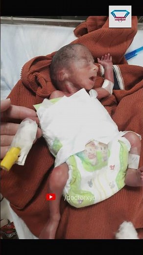 Premature Baby of about 24 Weeks | Doctor Xydi