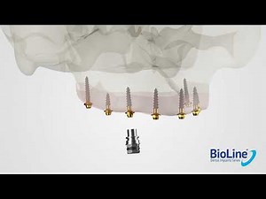 The All New BioLine Compressive Multi-Unit Implant !
