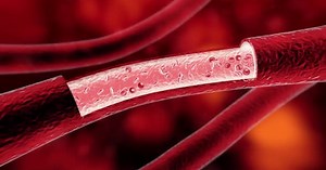 3d Illustration of Deep Vein Thrombosis or Blood Clots.