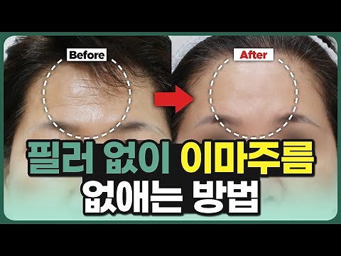 보톡스, 필러 없이 이마주름 없애는 법 l 청담동 피부과 전문의