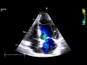 RUPTURE PAPILLARY MULSCLE SEVRE MR AMI