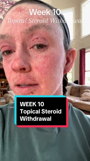 2 steps forward 1 step back but still healing & trending upwards! 🦎 👑 **I was prescribed topical steroids for 15 years to treat eczema. this does not happen to everyone that uses steroids. I am choosing to heal naturally at the moment with no other prescriptions. Have a good day :) ** #tsw #topicalsteroidwithdrawal #topicalsteroidaddiction #eczema #nmt #whole30 #topicalsteroidawareness