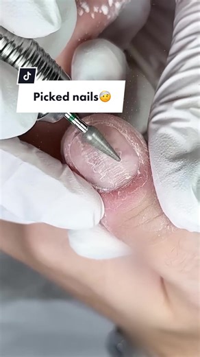 Transforming Picked Nails with Nail Prosthetics