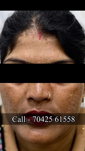 27K views · 145 reactions | @nisha_lambha call - ‪70425 61558‬ Address- CSC Market, Sec-18B, Dwarka, New Delhi - 110078 #pigmentationtreatment #skinwhiteningTreatment #spotmarktreatment #faceliftingTreatment #KoreanTreatment #Koreanglassskintreatment #facial | Nisha Lambha - Sparsh Beauty Care & Hair Treatment LLP | Facebook