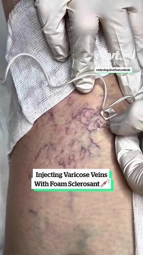 Injecting Veins With Foam Sclerosant 💉 #veins #medical #sclerotherapy