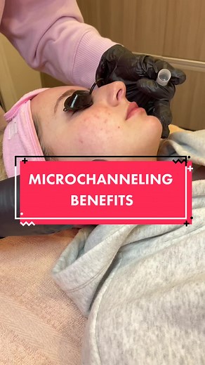 Follow along to see her results. Her first @Procell Microchanneling session. We are targeting post-inflammatory hyperpigmentation from previous acne. #acnetreatment #microchanneling #microchannelingtreatment #procelltherapies #procellmicrochanneling #ocesthetician #licensedesthetician #acneexpert
