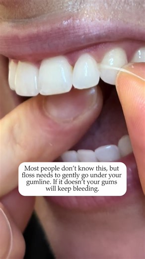 Most people don’t know this 👇 If your gums bleed when you floss, it’s usually a sign that bacteria is still sitting under the gums. Floss isn’t just meant to snap between your teeth. It should gently slide below the gumline to remove the plaque and bacteria that cause inflammation. If that bacteria isn’t removed, the bleeding will continue. Save this for your next flossing reminder 🦷 📱(250) 808-8400 📧 info@glenmoredental.ca 🌎glenmoredental.ca 📍103-1932 Summit Drive, Kelowna BC #Kelownadent