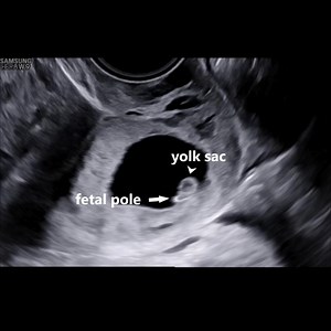 11K views · 229 reactions | Today is #ectopicpregnancyawarenessday and the #VISUOG chapter on cervical ectopic pregnancy is open access throughout August! https://bit.ly/3WLAbaF #ThinkEctopic Enjoy our VISUOG chapters? Access all of them with #ISUOG membership - plus, there's 10% discount if you use code VISUOG10. Go to: https://bit.ly/3W5587c #loveultrasound | International Society of Ultrasound in Obstetrics and Gynecology (ISUOG) | Facebook