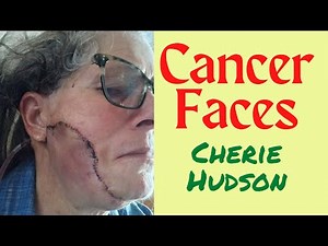Cherie Hudson's Cancerface Journey with Amelanotic Melanoma