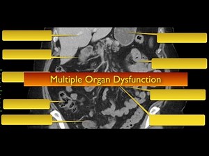 The Devastating Domino Effect: Understanding Multiple Organ Dysfunction Syndrome