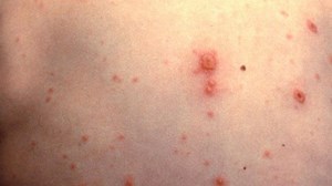 Ruby Valley Medical Center issues guidance after local chicken pox case confirmed