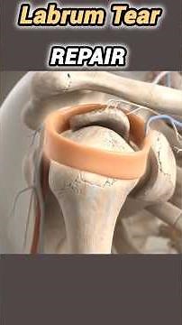 Labrum Tear Repair (3D Animation)#labrumtear#shoulder#pain#repair#3danimationless#surgery#bonehealth