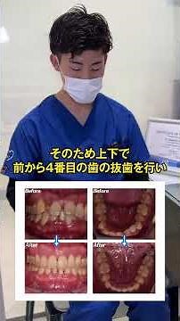 歯列矯正ビフォーアフター１人目！ #歯科 #歯医者 #矯正歯科 #クリア歯科 #美容