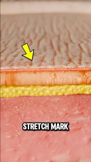 How Stretch Marks Really Form
