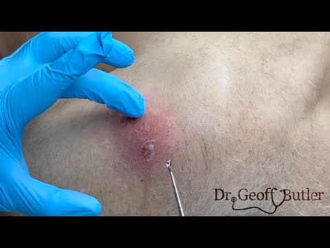 Drainage of an early abscess