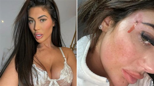 Chloe Ferry shows off 'new face' after botched surgery fix