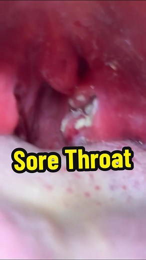 #tonsil #tonsilitis #tonsilstonesremoval Tonsillitis, or sore throat | tonsil stones