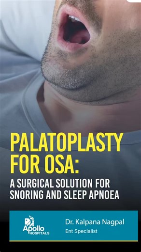 SampurnHealthexpert | Teleconsultation on Instagram: "PALATOPLASTY FOR OSA A SURGICAL SOLUTION FOR SNORING AND SLEEP APNEA. Loud Snoring Isn’t Normal — It Could Be Obstructive Sleep Apnea Loud snoring, choking or breathing pauses during sleep, and excessive daytime sleepines s are not just signs of poor sleep habits. They may indicate Obstructive Sleep Apnea (OSA) — a serious sleep-related breathing disorder. OSA occurs when the airway repeatedly collapses during sleep, often due to lax or exces